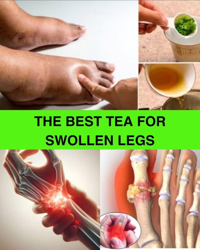 Drink this tea, and you’ll never have swollen legs, ankles, or feet again! 👇