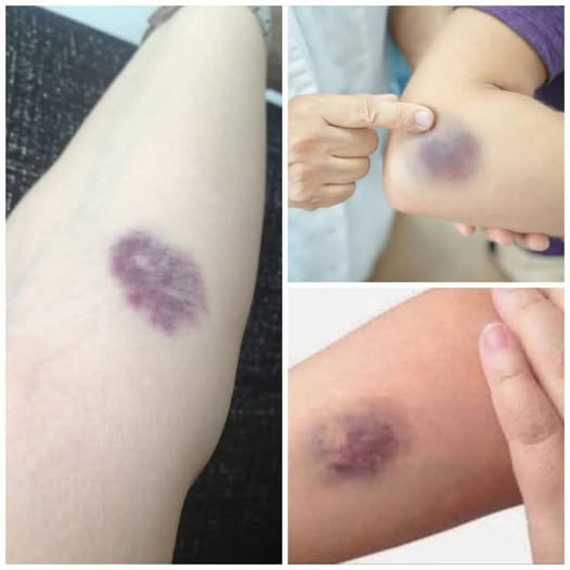 ⚠️ BE CAREFUL, if you get these bruises on your body, it means you have…