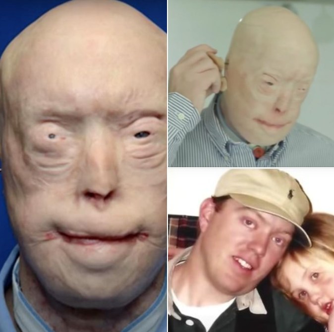 He suffered devastating burns when he tried to rescue a woman trapped in a fire. For years, he was terrified to show his face to the world, and wore caps, sunglasses and prosthetic ears in public. A few years ago, Patrick got the most extensive face transplant ever. I was not ready for how he looks now, and you won’t be either 💔 😳👇 Check 1st comment