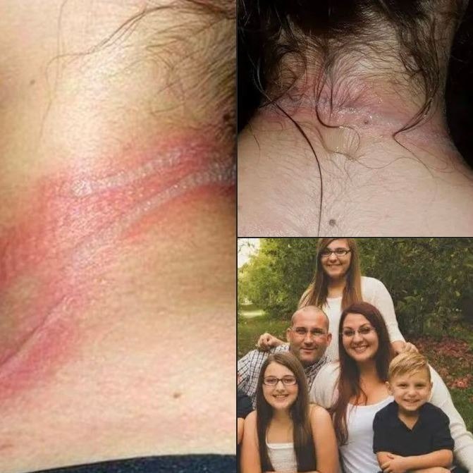 She looked at her little girl and saw devastating wounds on her neck. When she realized what had happened, she was beside herself 😱 Be careful, because it can happen to your child as well 😞 Full story in Comments 👇