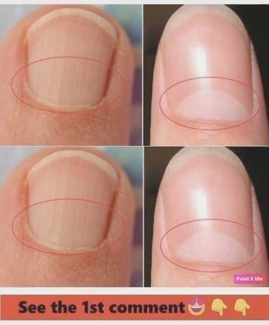 If You Don’t Have A Half Moon Shape On Your Nails, Visit A DOCTOR Immediately.. Continue Reading below first Comment👇