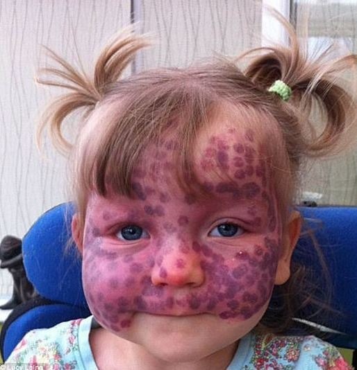 This precious little girl was born covered in ‘polka dots’. At first, her parents thought they were just bruises, but when they got to the doctor they found out the truth. Check comments 👇